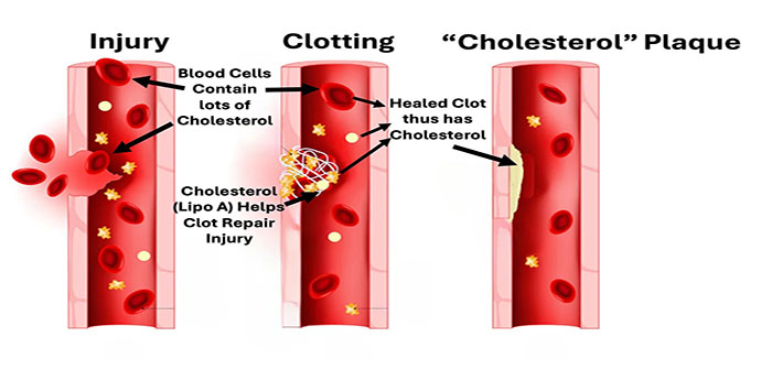 Arteries_Injury_Clotting_Cholesterol_Plaque