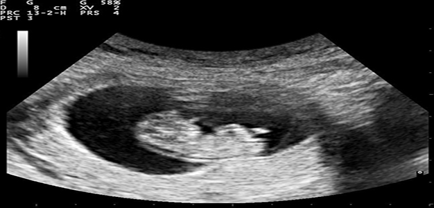 Pregnancy_ultrasound